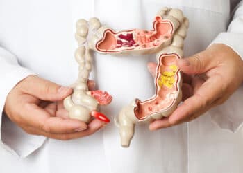 Câncer colorretal: prevenção e detecção precoce são fundamentais, alerta oncologista