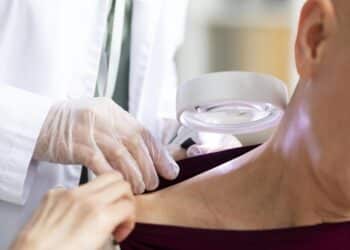 Psoríase: álcool e cigarro podem agravar o quadro da doença