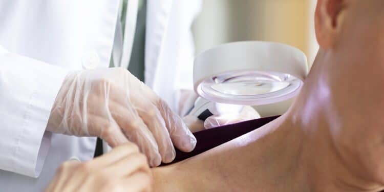 Psoríase: álcool e cigarro podem agravar o quadro da doença