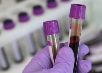 REINO UNIDO INDENIZARÁ PESSOAS QUE RECEBERAM TRANSFUSÃO DE SANGUE CONTAMINADO COM HIV