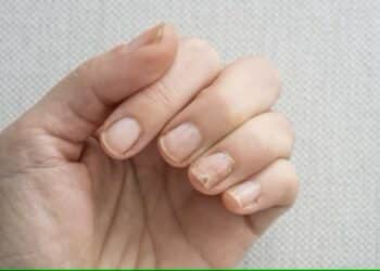 Conheça 4 alterações nas unhas que podem indicar problemas de saúde