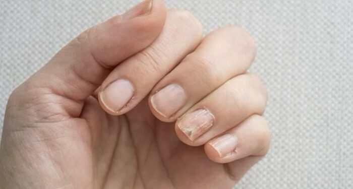 Conheça 4 alterações nas unhas que podem indicar problemas de saúde