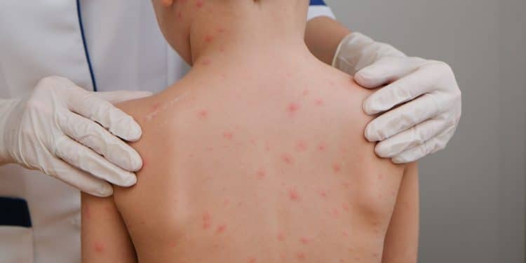 Saúde reforça importância da vacinação diante de casos suspeitos de sarampo na região