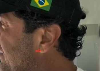 Dobra na orelha: após morte de influenciador, médicos explicam qual a relação do ‘sinal de Frank’ com risco de infarto