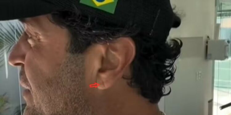 Dobra na orelha: após morte de influenciador, médicos explicam qual a relação do ‘sinal de Frank’ com risco de infarto