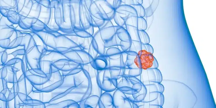 SUS adotará exame não invasivo para identificar câncer de intestino