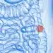 SUS adotará exame não invasivo para identificar câncer de intestino
